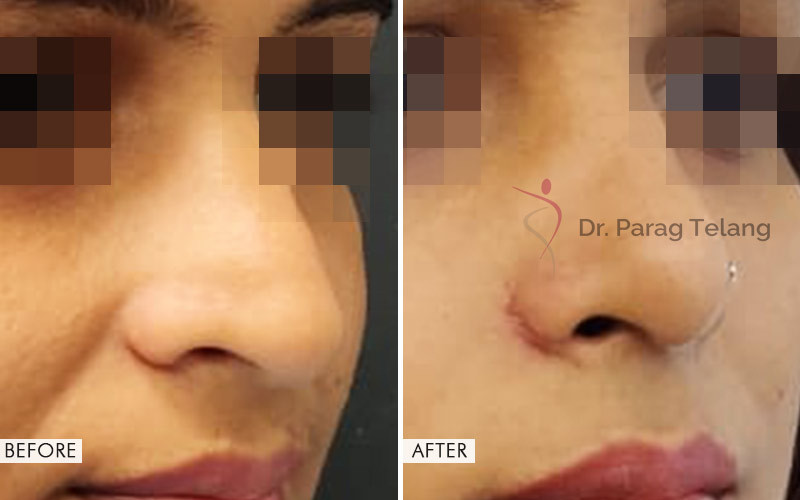 Rhinoplasty