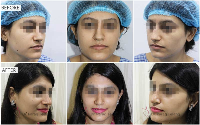 Rhinoplasty