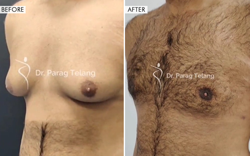 Gynecomastia