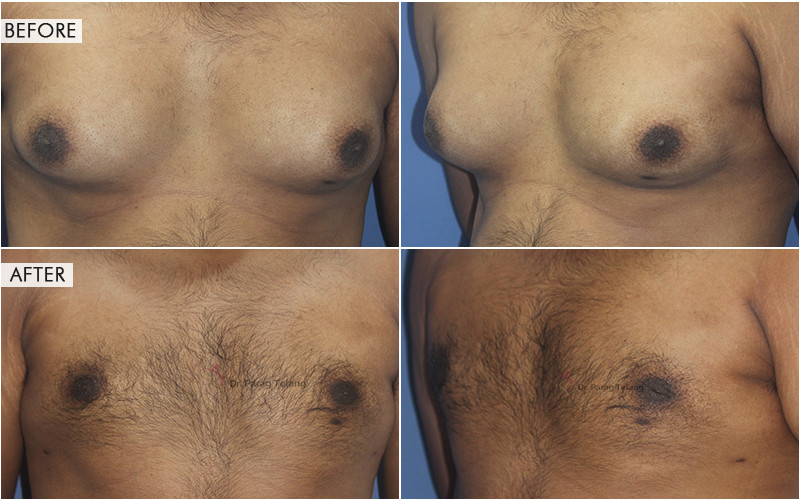 Gynecomastia