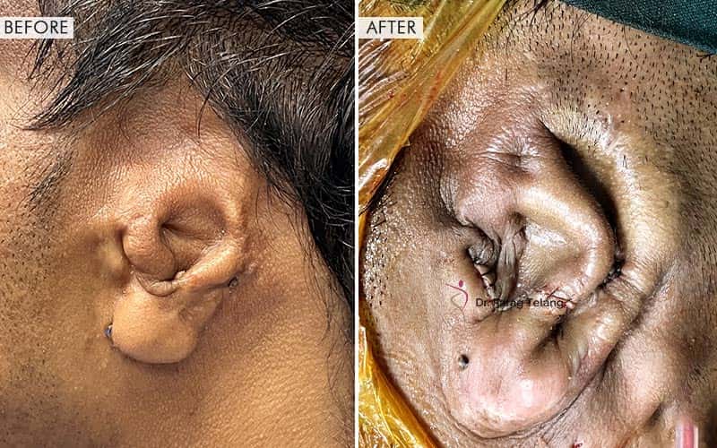 Traumatic Ear Loss